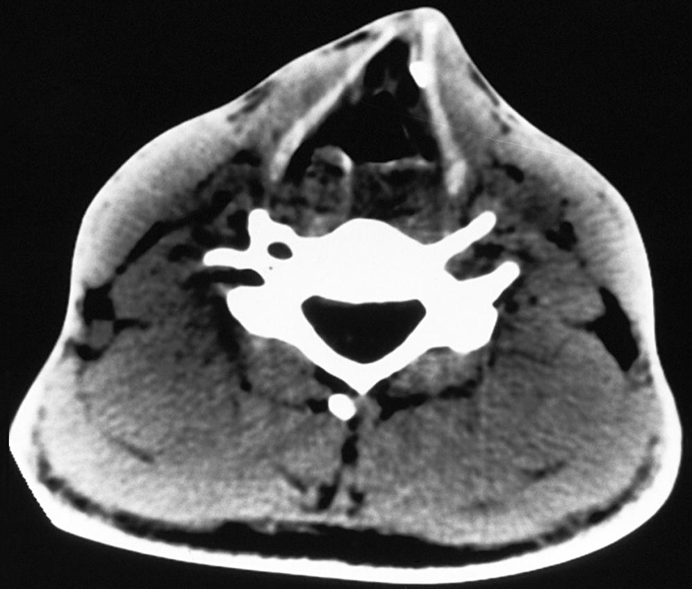 Fig. 8.4, Computed tomography scan shows diffuse subcutaneous emphysema. Asymmetry of the laryngeal framework suggests a fracture of the larynx.