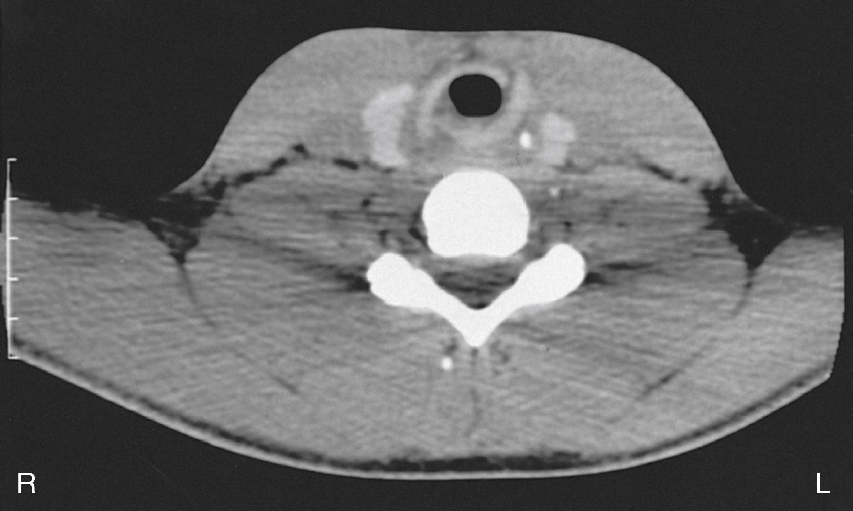 Fig. 8.5, This telescoping fracture of the cricoid cartilage was the result of strangulation.