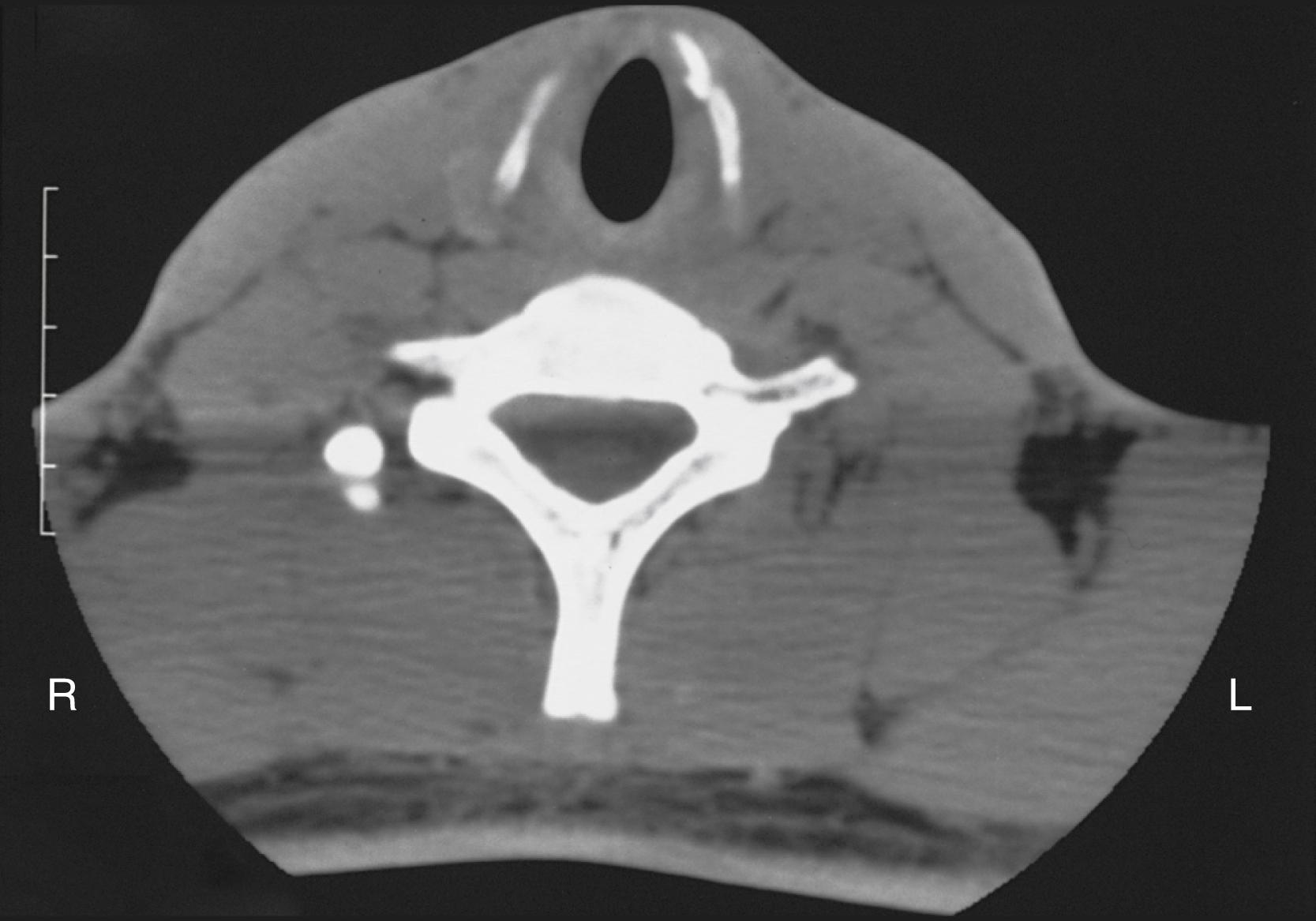 Fig. 8.6, Minimal displacement of the thyroid cartilage demonstrated on computed tomography scan.