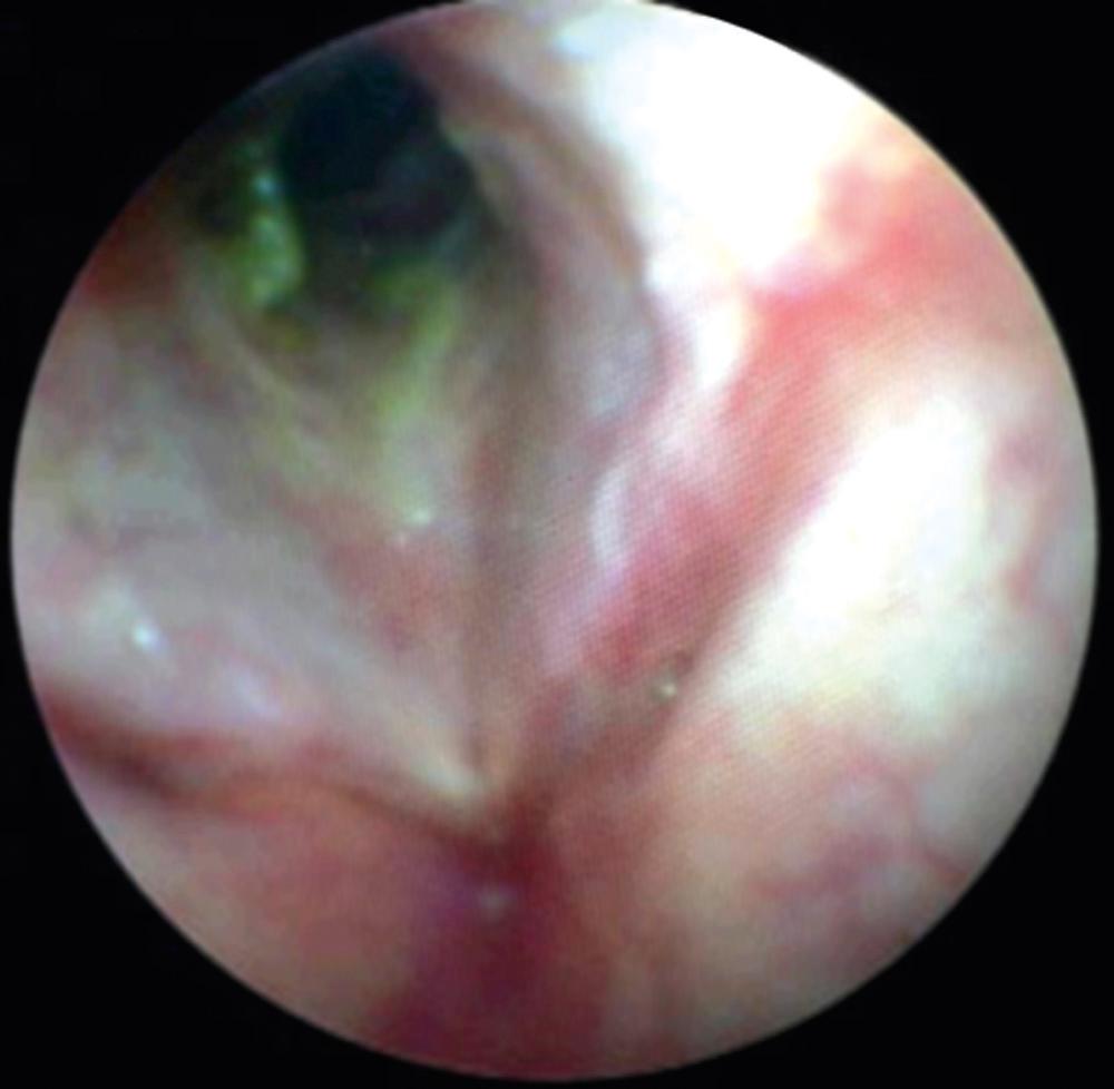 Fig. 11.1, Active granulomatosis with polyangiitis (formerly Wegener granulomatosis).