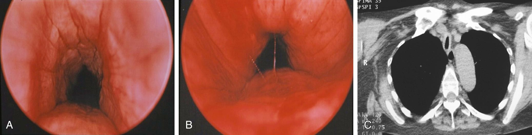 Fig. 11.2, A 65-year-old woman referred for progressive airway symptoms after recent intubation was also noted to have saddle nose deformity. (A) Endoscopic view during inspiration demonstrates thickening of tracheal mucosa and absence of normal tracheal rings. (B) Endoscopic view demonstrates collapse of airway during expiration. (C) Chest computed tomography demonstrates thickening of tracheal wall and partial collapse.