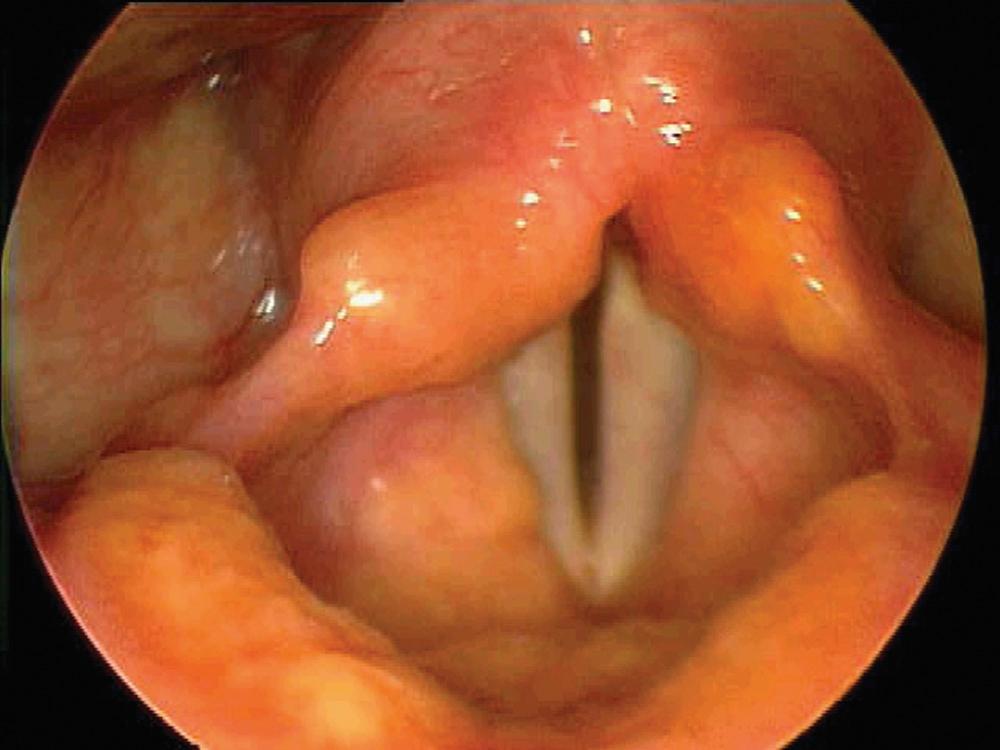 Fig. 11.4, Laryngeal amyloid deposition in the supraglottis (right ventricular fold, laryngeal surface of epiglottis) and sparing of the true vocal folds. The patient came to medical attention with hoarseness and a nonproductive cough.