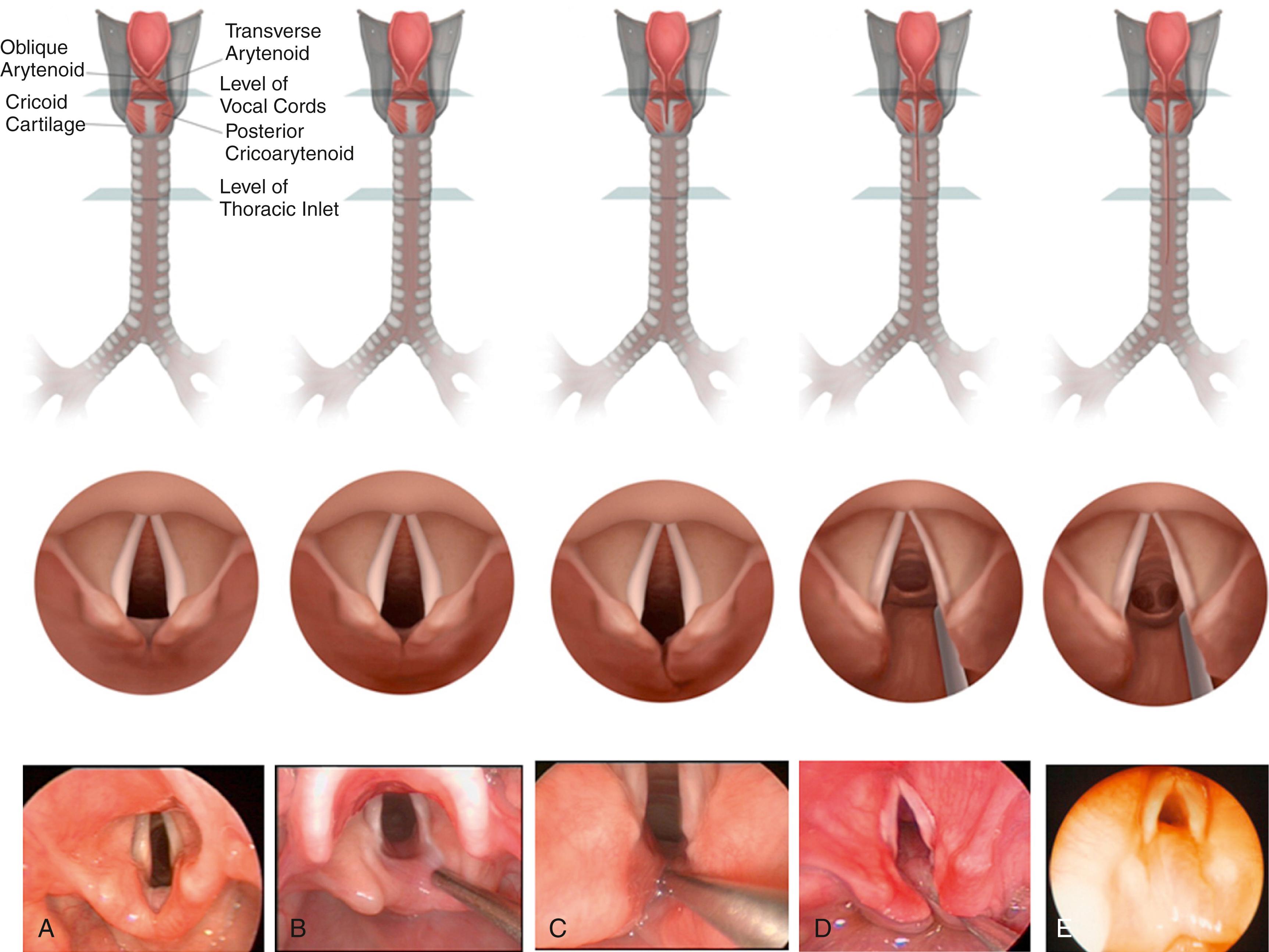 Fig. 31.1, Benjamin-Inglis classification of laryngeal cleft, with posterior schematic view (top), superior schematic view (middle), and intraoperative endoscopic view (bottom). (A) Normal larynx. (B) Type 1 cleft. (C) Type 2 cleft. (D) Type 3 cleft. (E) Type 4 cleft.