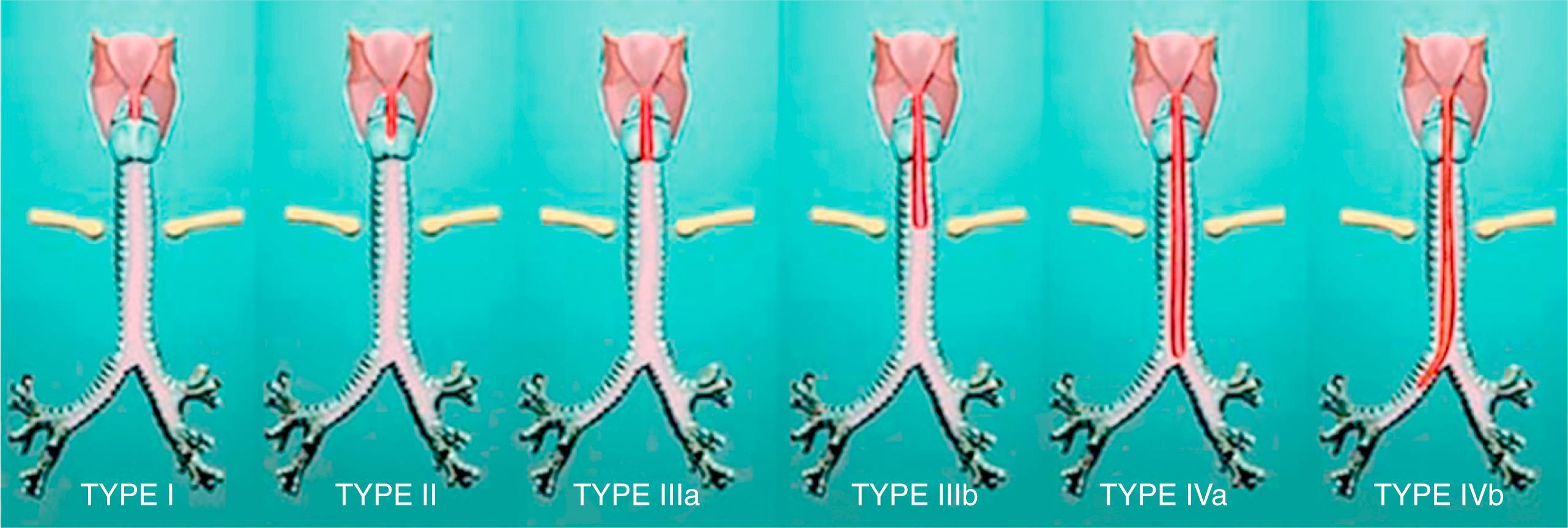 Fig. 31.2, Modification of the Benjamin-Inglis classification of laryngeal cleft using subclassification for types 3 and 4.