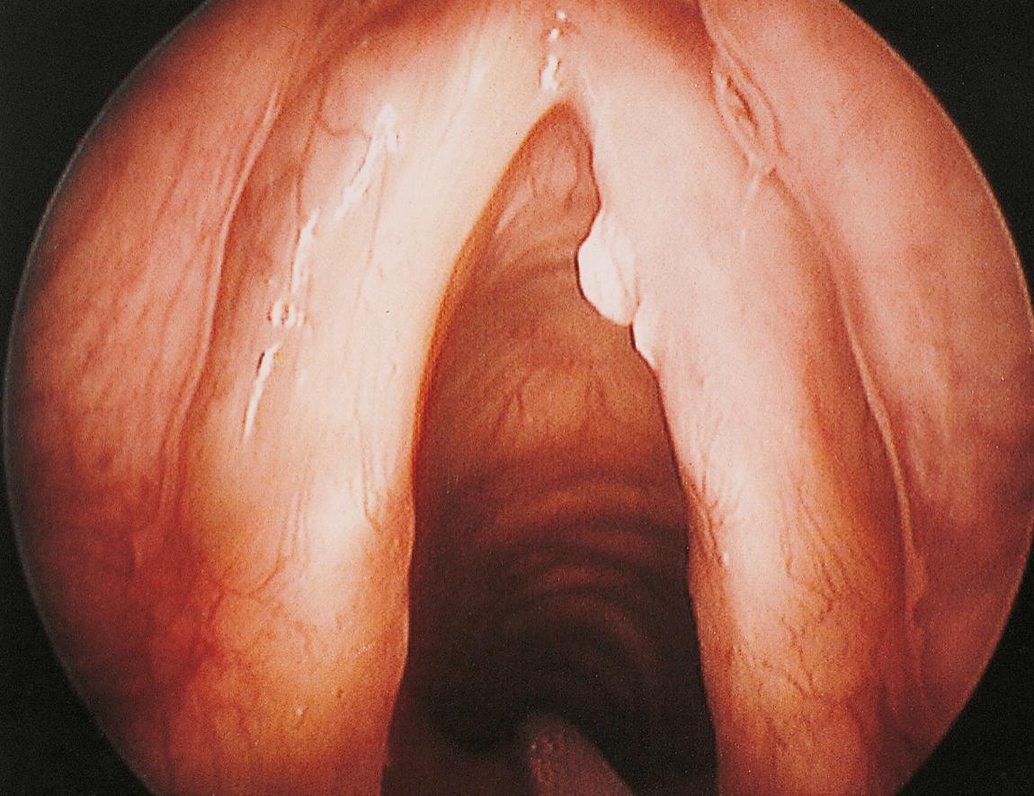 Figure 10.19, Carcinoma in situ presenting as a keratotic nodule of the right vocal cord.