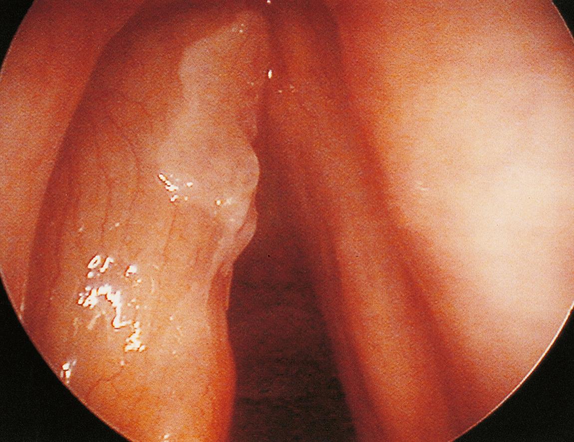 Figure 10.20, Superficial carcinosarcoma of the left true vocal cord.