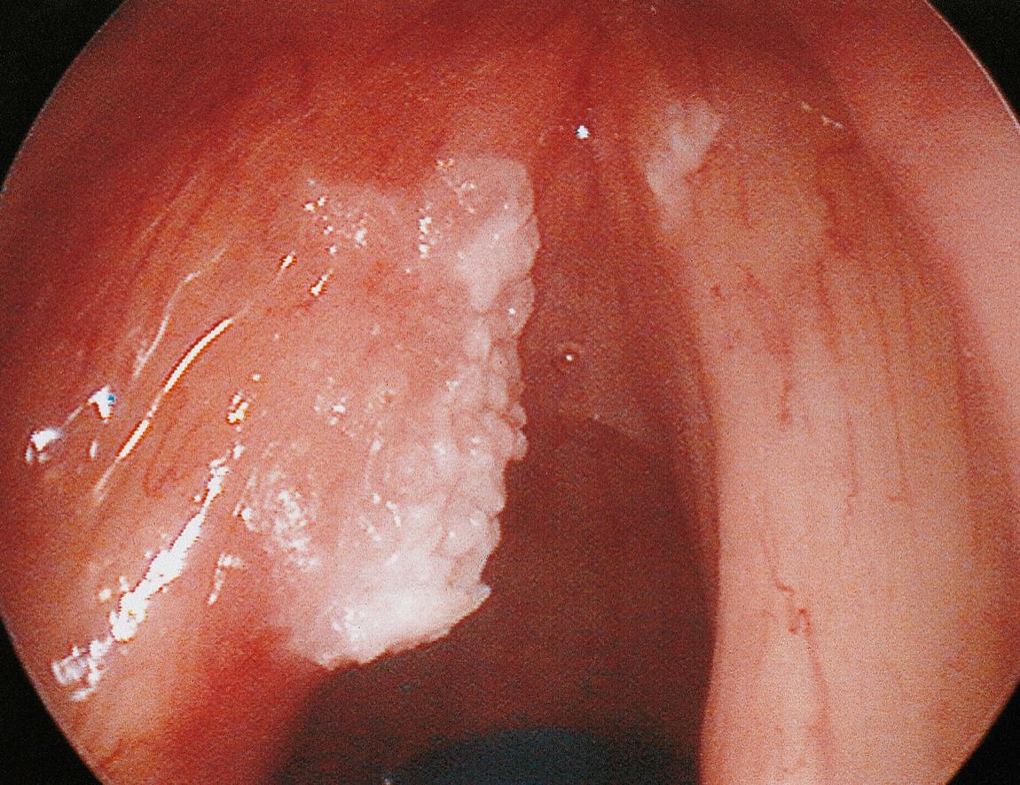 Figure 10.21, Papillary squamous carcinoma of the left true vocal cord.