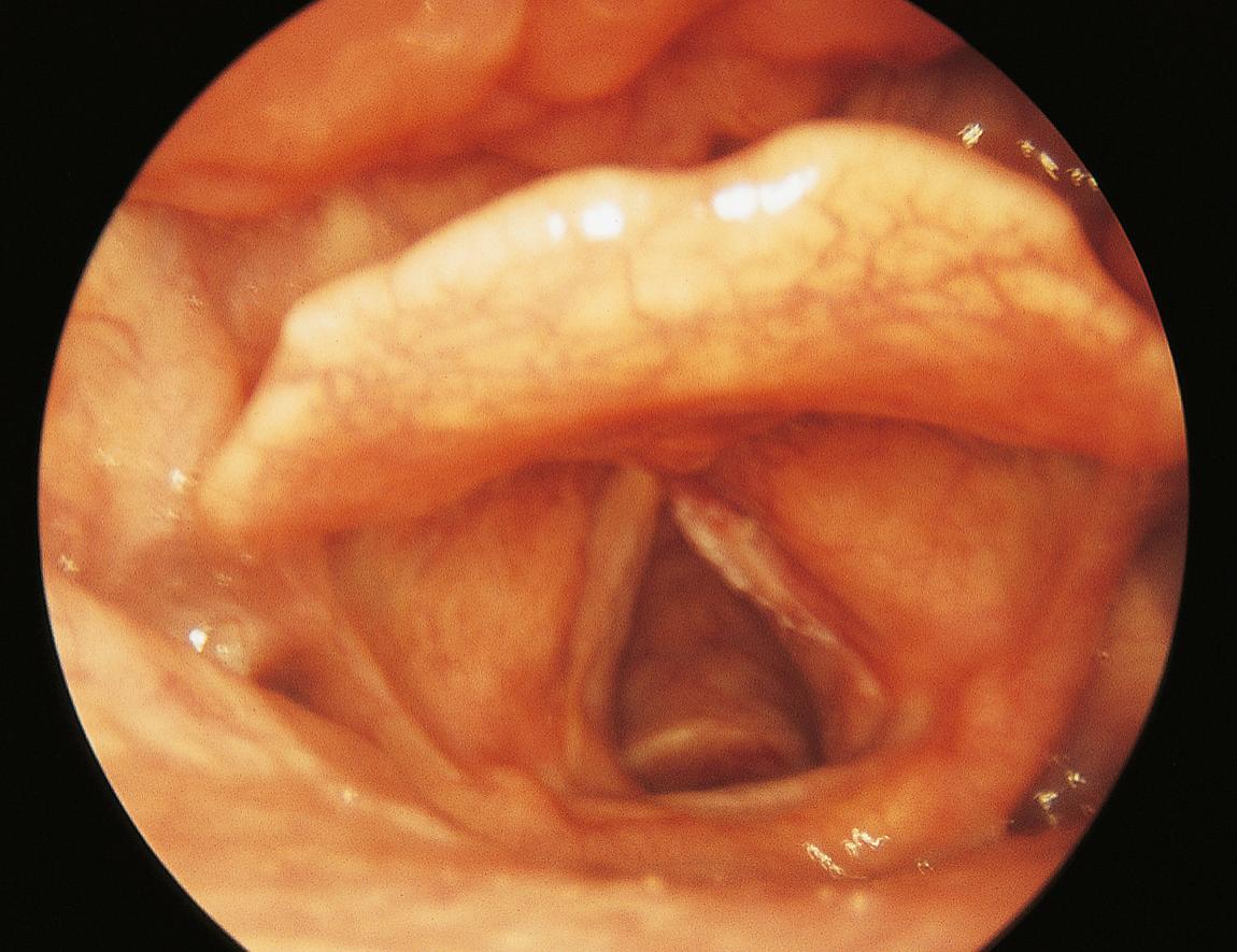 Figure 10.22, Ulcerated squamous cell carcinoma of the right vocal cord, viewed during quiet breathing.