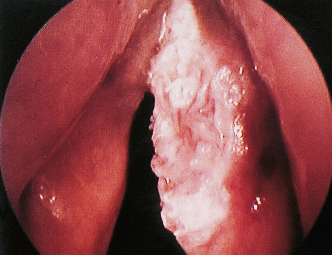 Figure 10.24, Ulcerated exophytic keratotic squamous carcinoma of the right vocal cord.