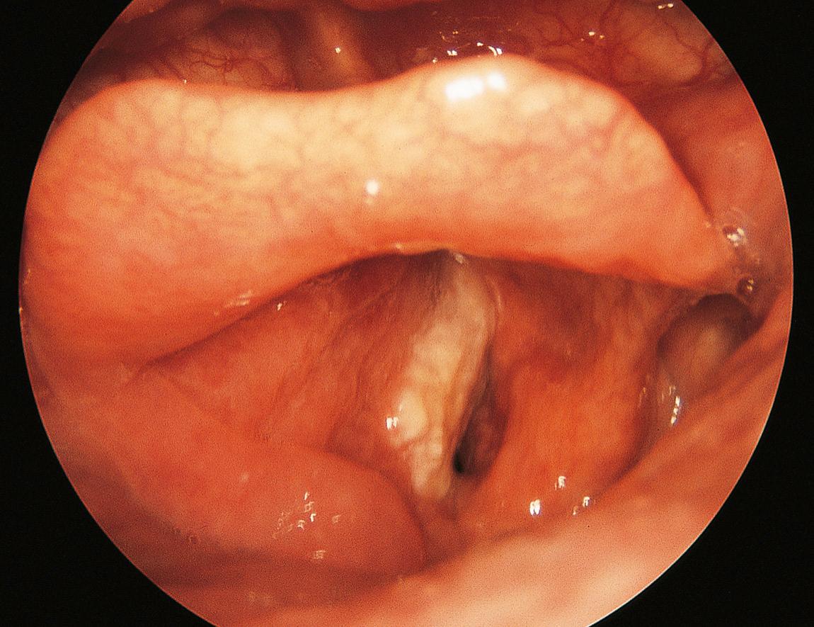 Figure 10.25, Squamous carcinoma of the left vocal cord with fixation.