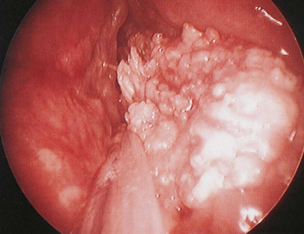 Figure 10.26, Papillary verrucous carcinoma of the right arytenoid.