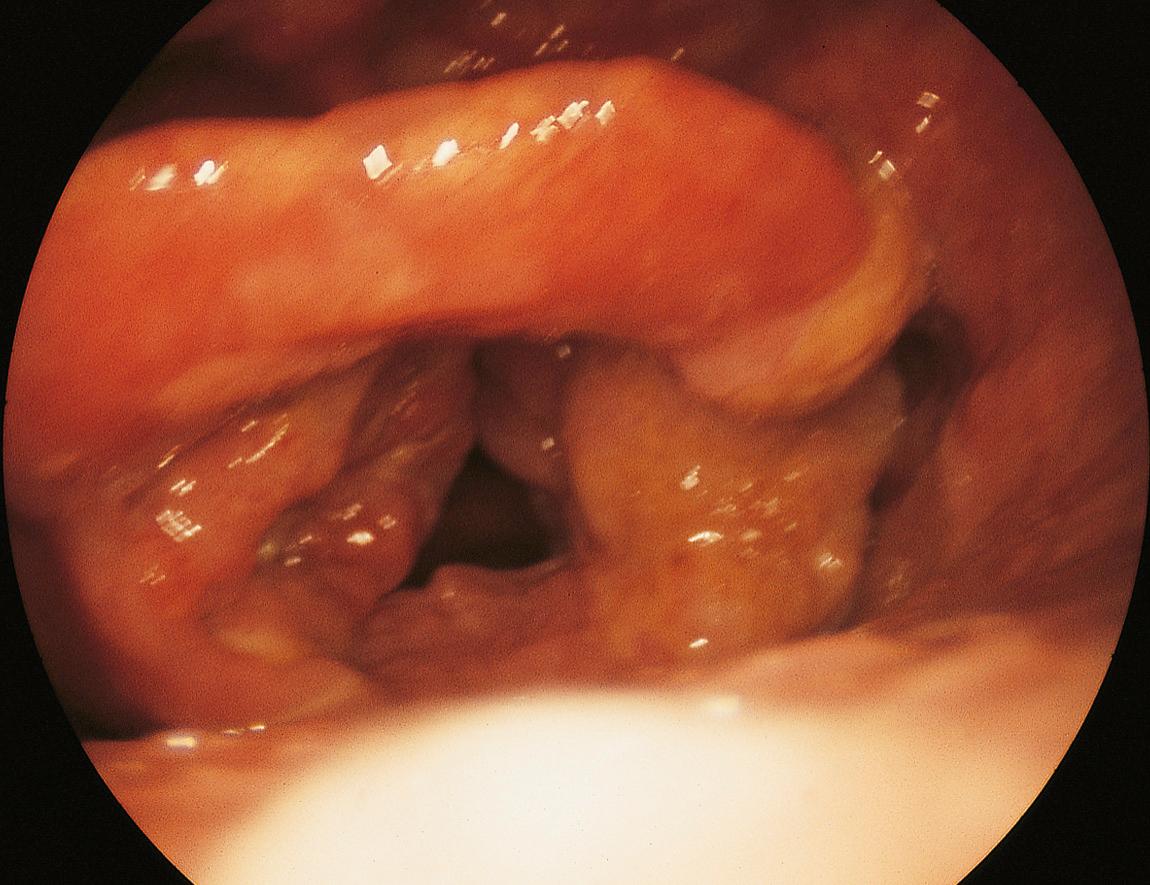 Figure 10.27, Squamous carcinoma of the right aryepiglottic fold.