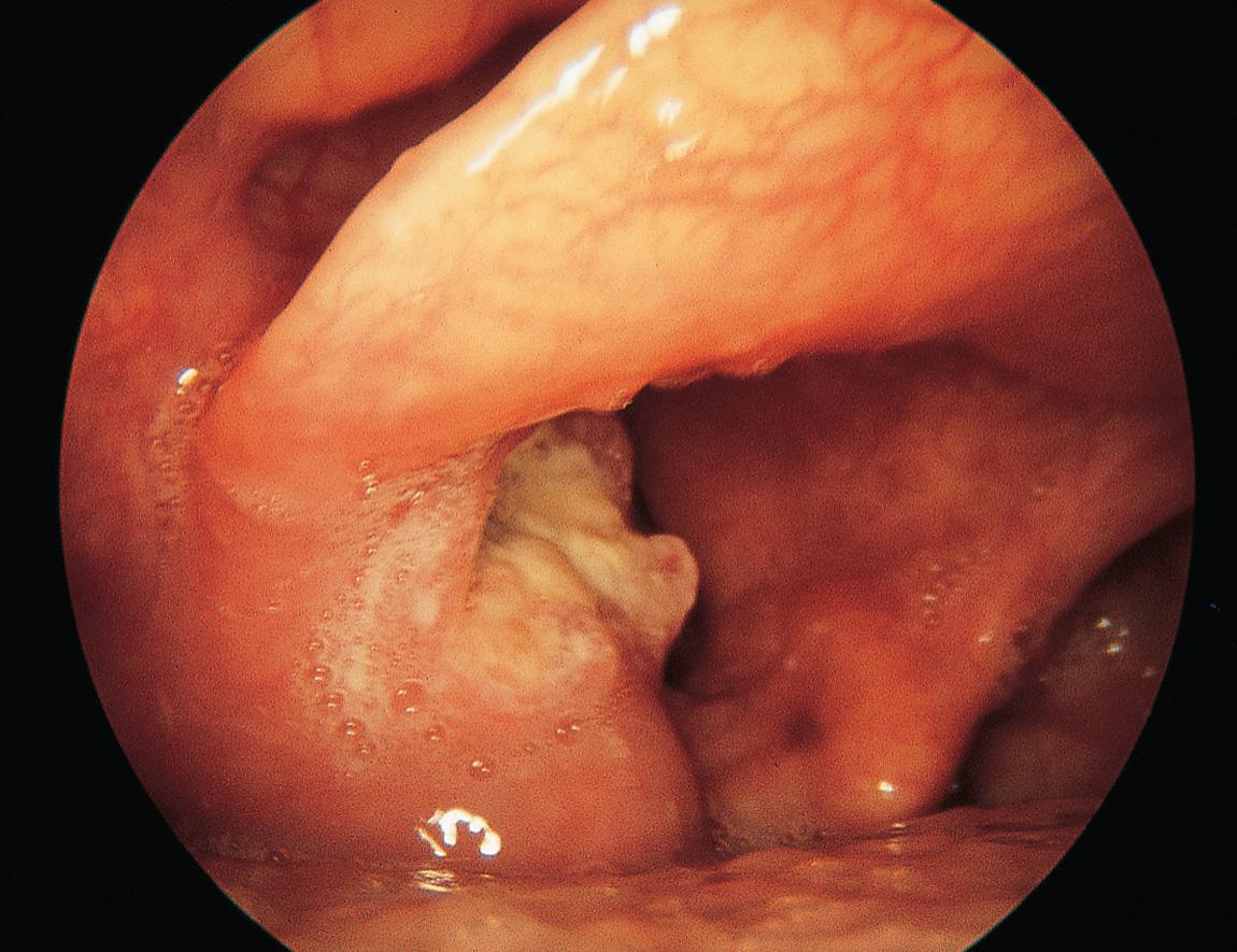 Figure 10.28, Squamous carcinoma of the left arytenoid.