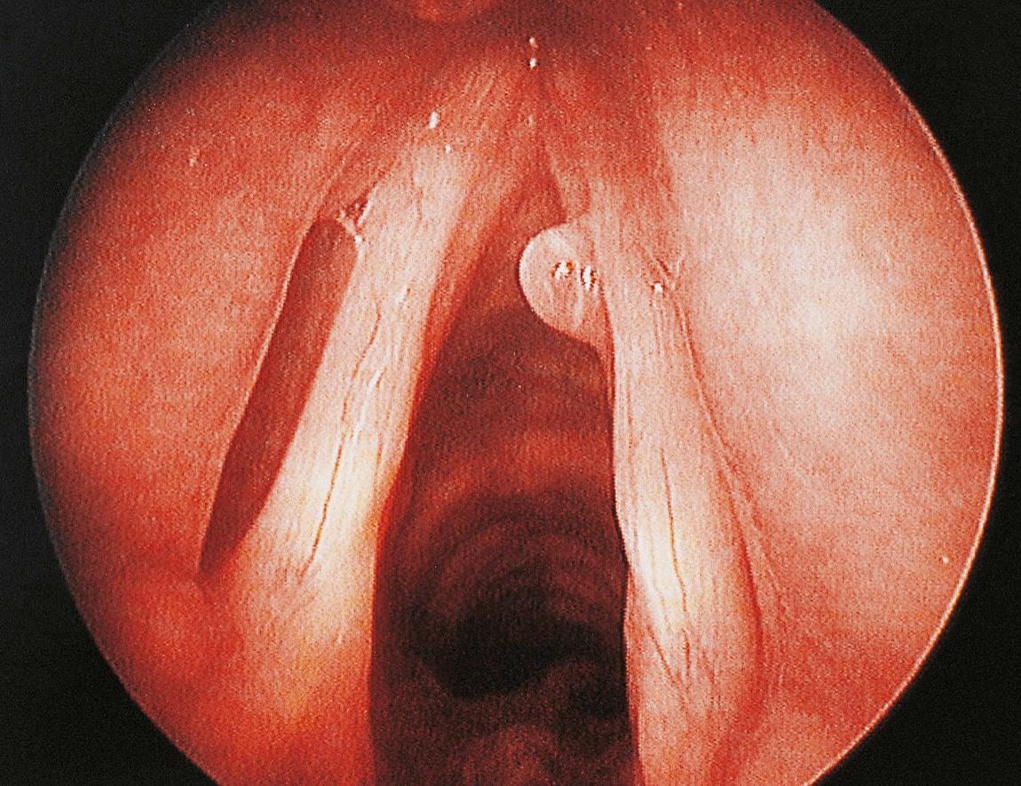 Figure 10.10, Benign mucosal polyp on the free edge of the anterior third of the right vocal cord.