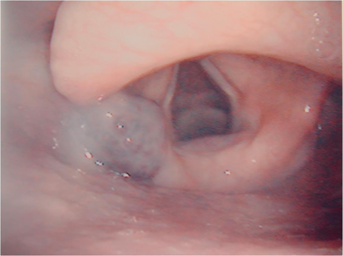 Figure 10.29, Hemangioma of the left pyriform sinus.