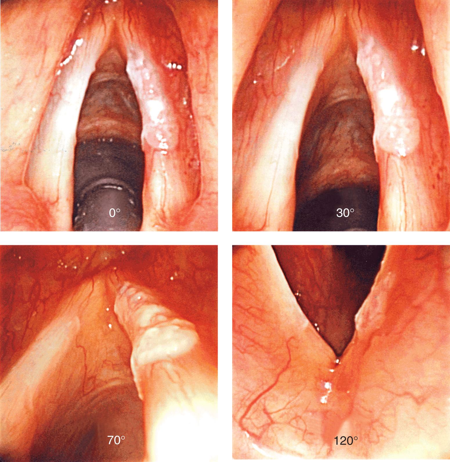 Figure 10.31, Examination under anesthesia with rigid telescopes showing extent of early stage vocal cord carcinoma.