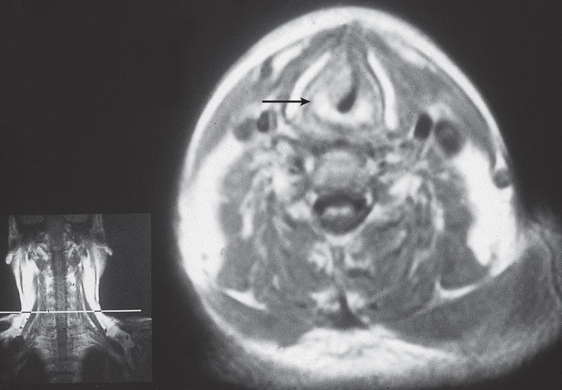 Figure 10.32, MRI scan in axial view shows tumor of the right vocal cord ( arrow ).