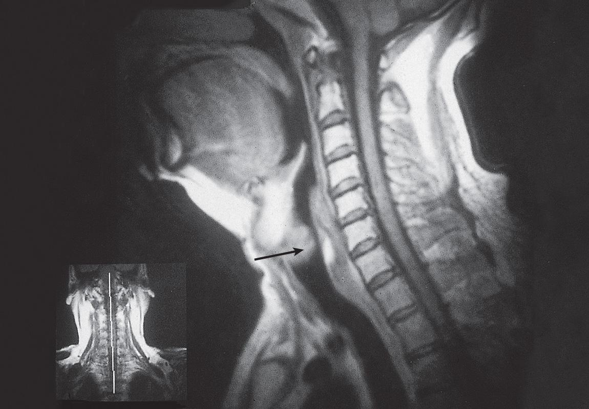 Figure 10.34, Sagittal view of the MRI scan shows transglottic tumor ( arrow ).