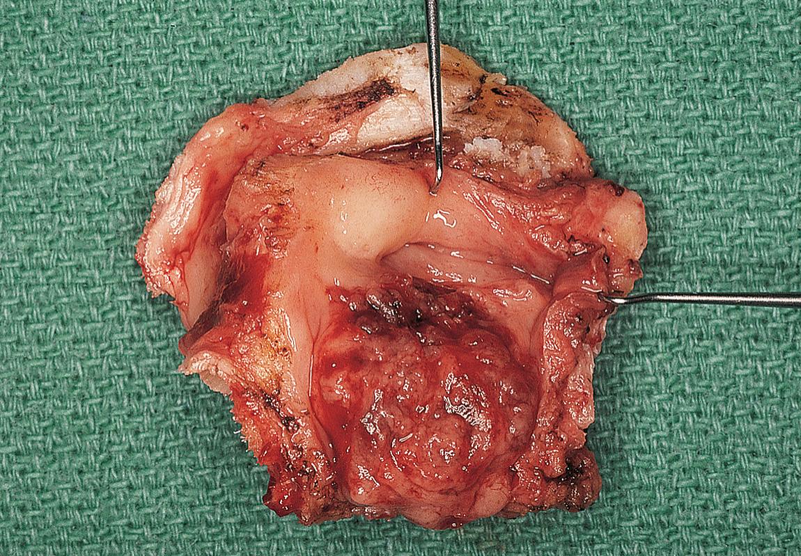 Figure 10.35, The surgical specimen of hemilaryngectomy showing transglottic tumor.