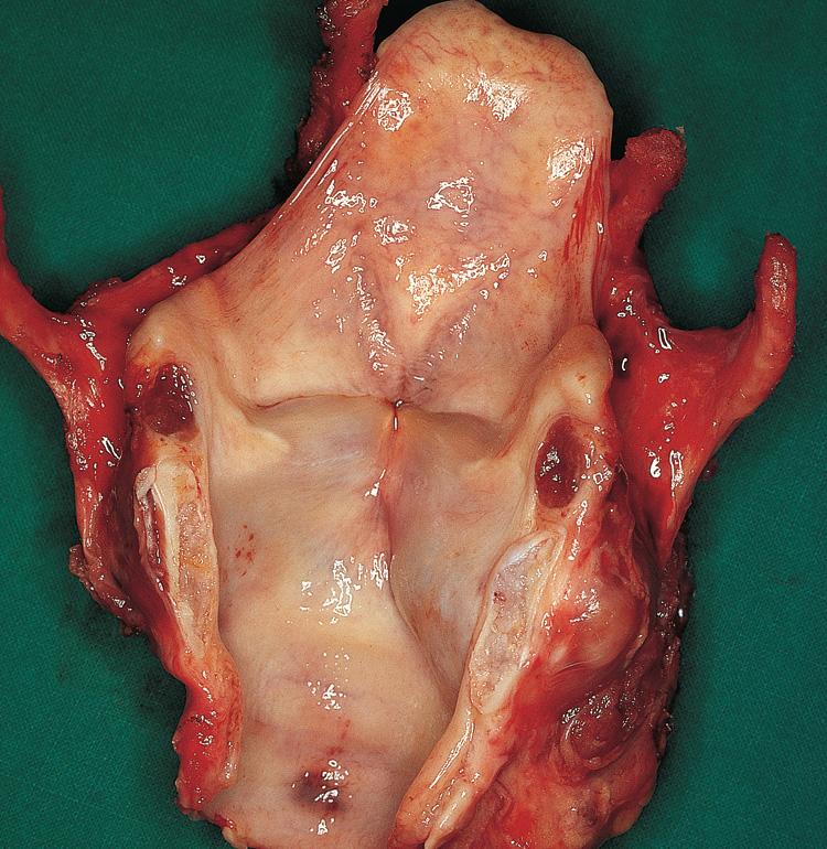 Figure 10.37, The surgical specimen of total laryngectomy done for chondrosarcoma of the cricoid cartilage, shown on the CT scan in Fig. 10.36 .