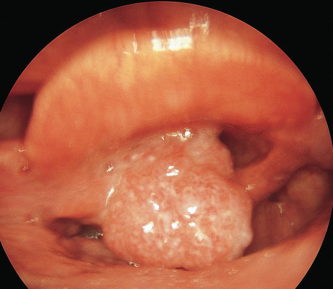 Figure 10.40, Telescopic view of the larynx showing a tumor of the aryepiglottic fold.