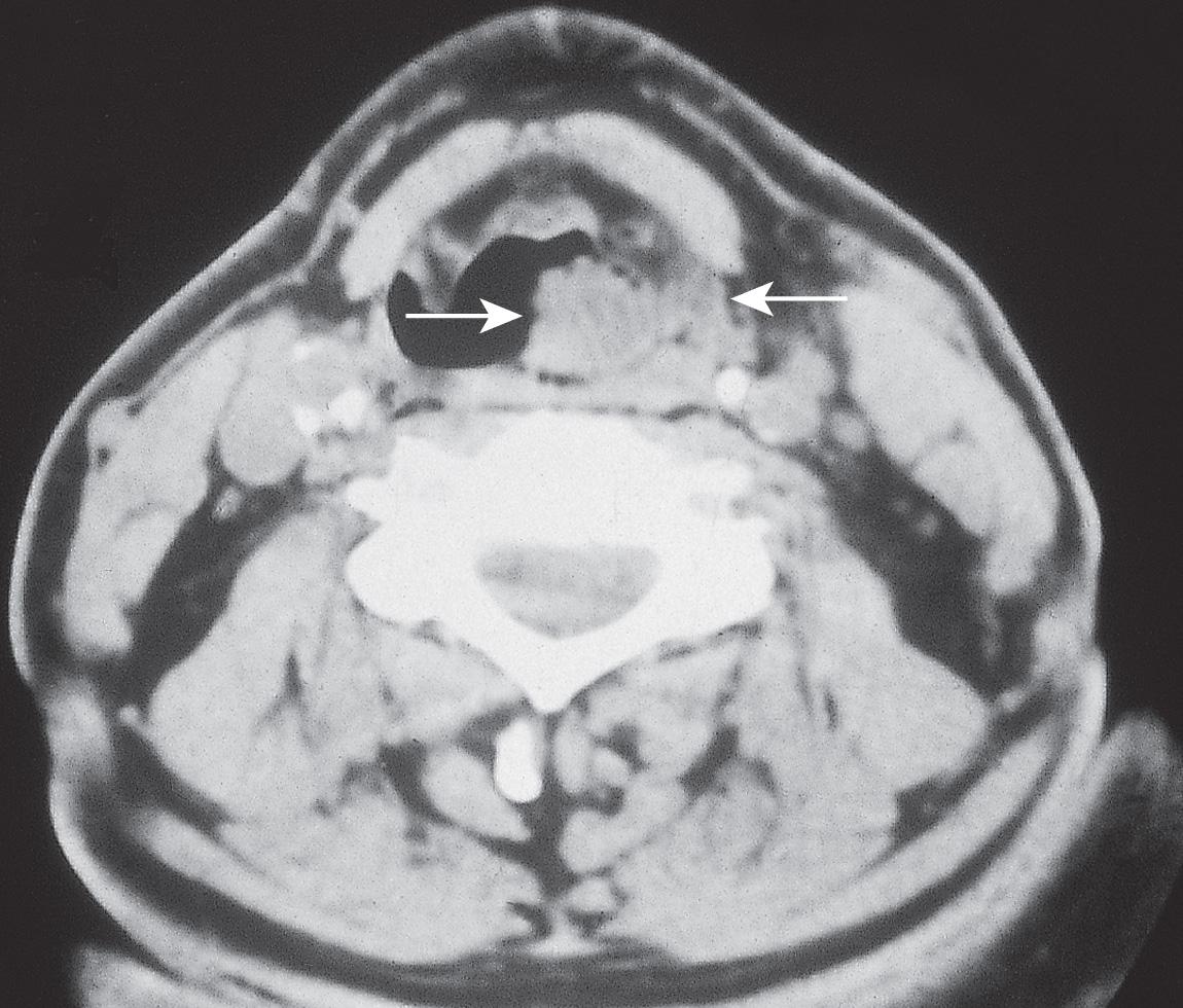 Figure 10.41, CT scan showing one lesion on the aryepiglottic fold ( left arrow ) and a second lesion on the lateral wall of the pyriform sinus ( right arrow ).