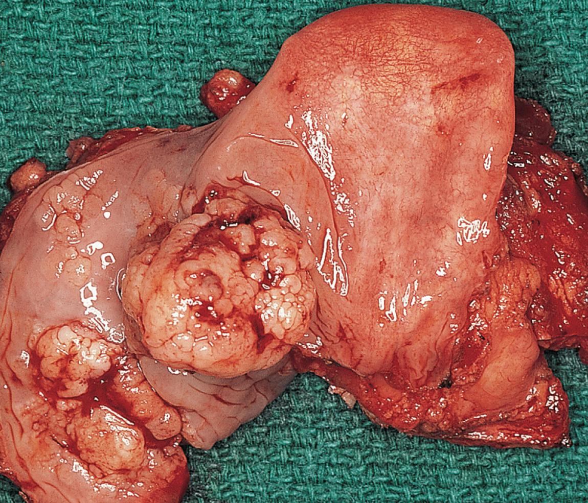 Figure 10.42, The surgical specimen of the tumors shown in Fig. 10.41 .