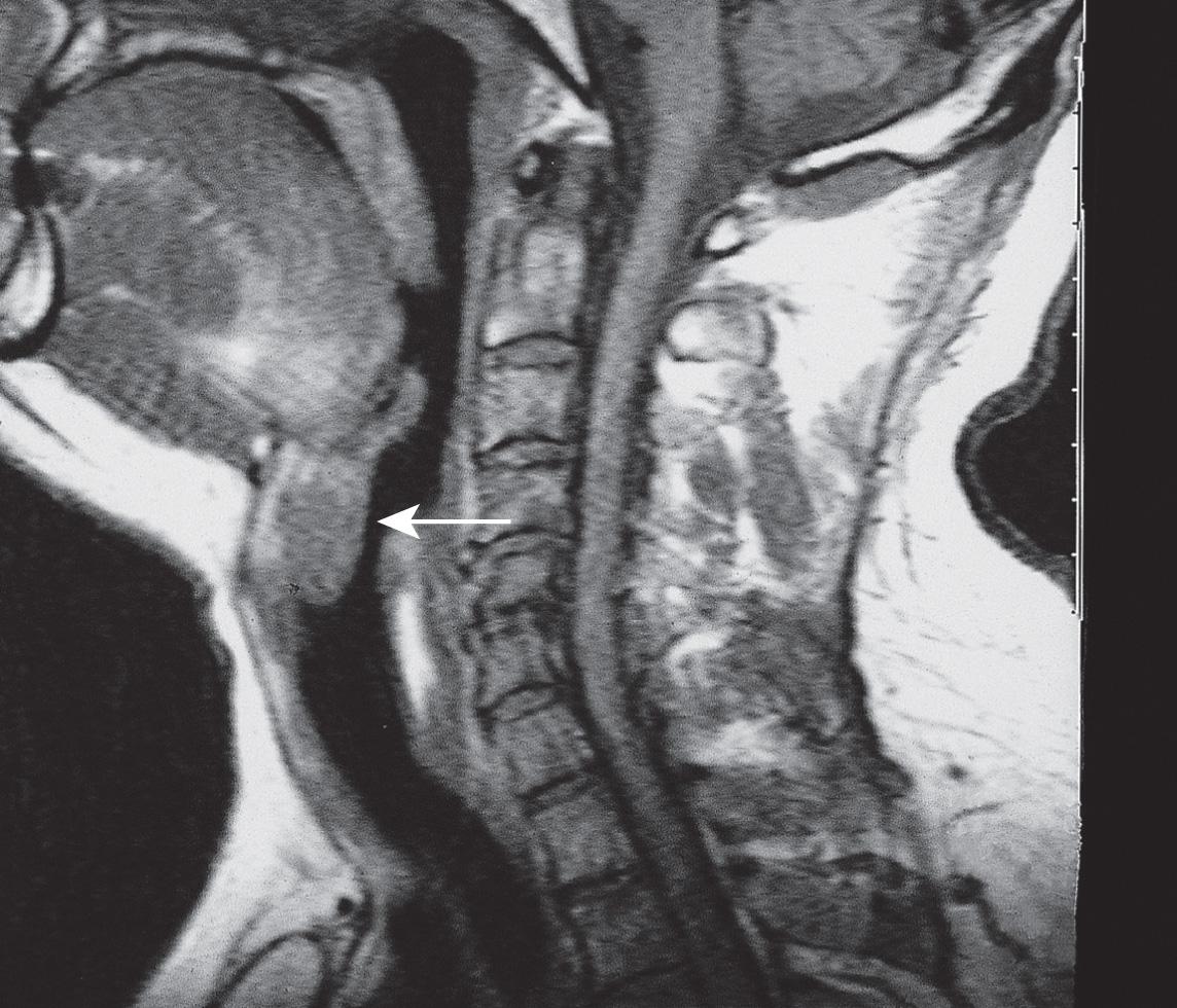 Figure 10.43, Sagittal view of the MRI scan showing a submucosal lesion of the infrahyoid portion of the epiglottis ( arrow ).