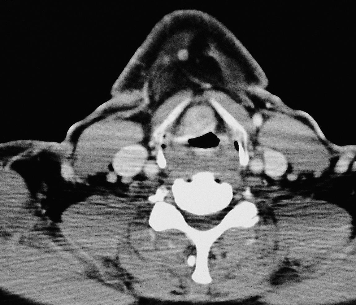 Figure 10.44, Axial view of the MRI showing extension into the preepiglottic space.