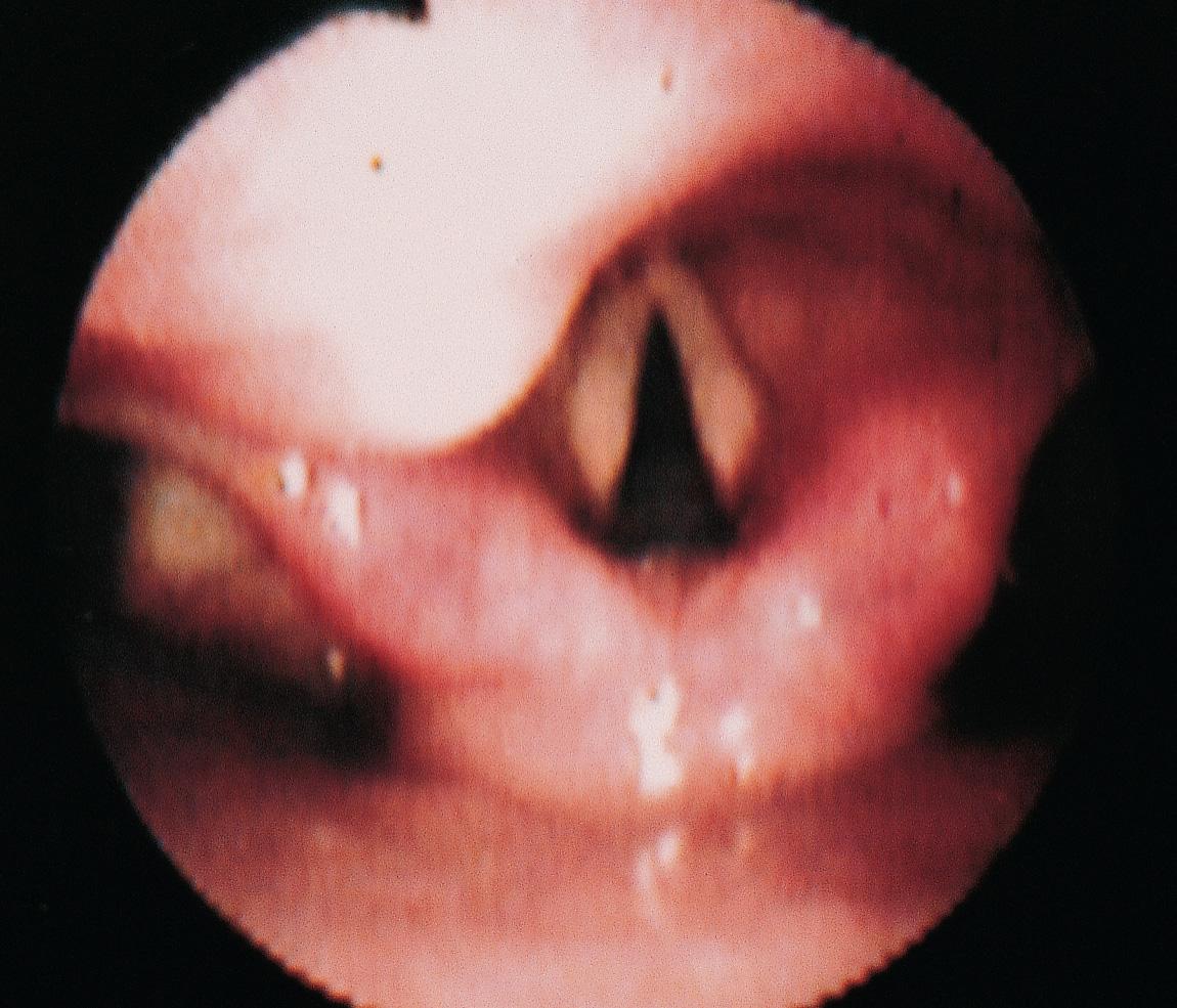 Figure 10.47, Endoscopic examination revealed a smooth submucosal lesion involving the laryngeal surface of the epiglottis.