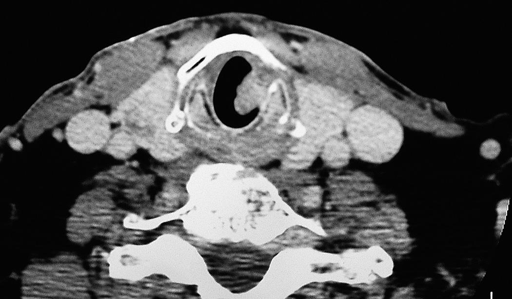 Figure 10.48, Axial view of the CT scan of a patient showing tumor in the subglottic region.