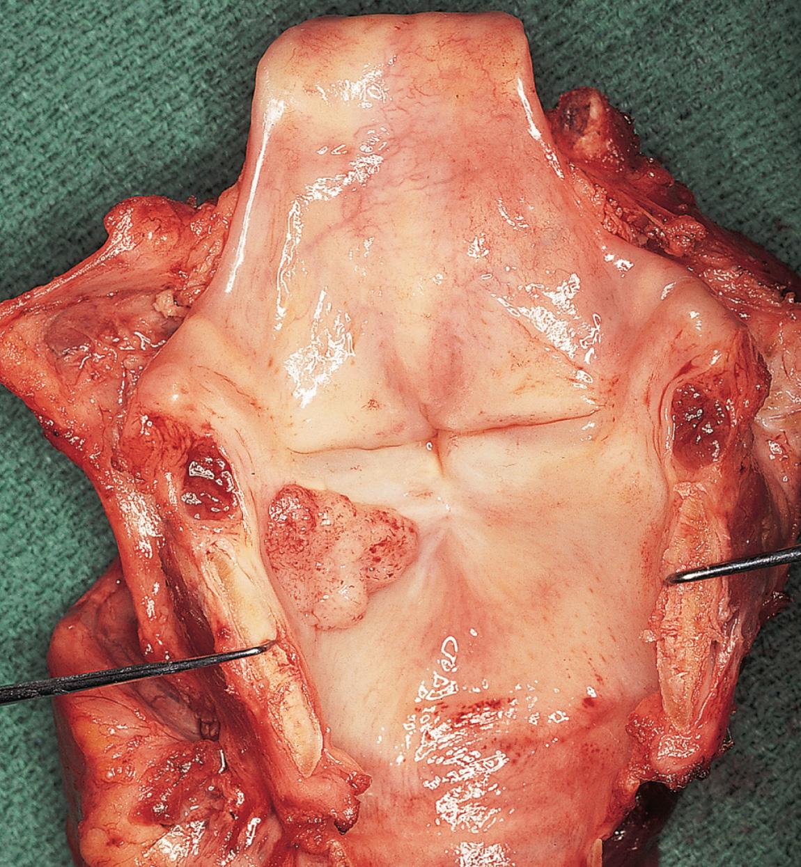 Figure 10.49, Total laryngectomy specimen of the patient shown in Fig. 10.47 .