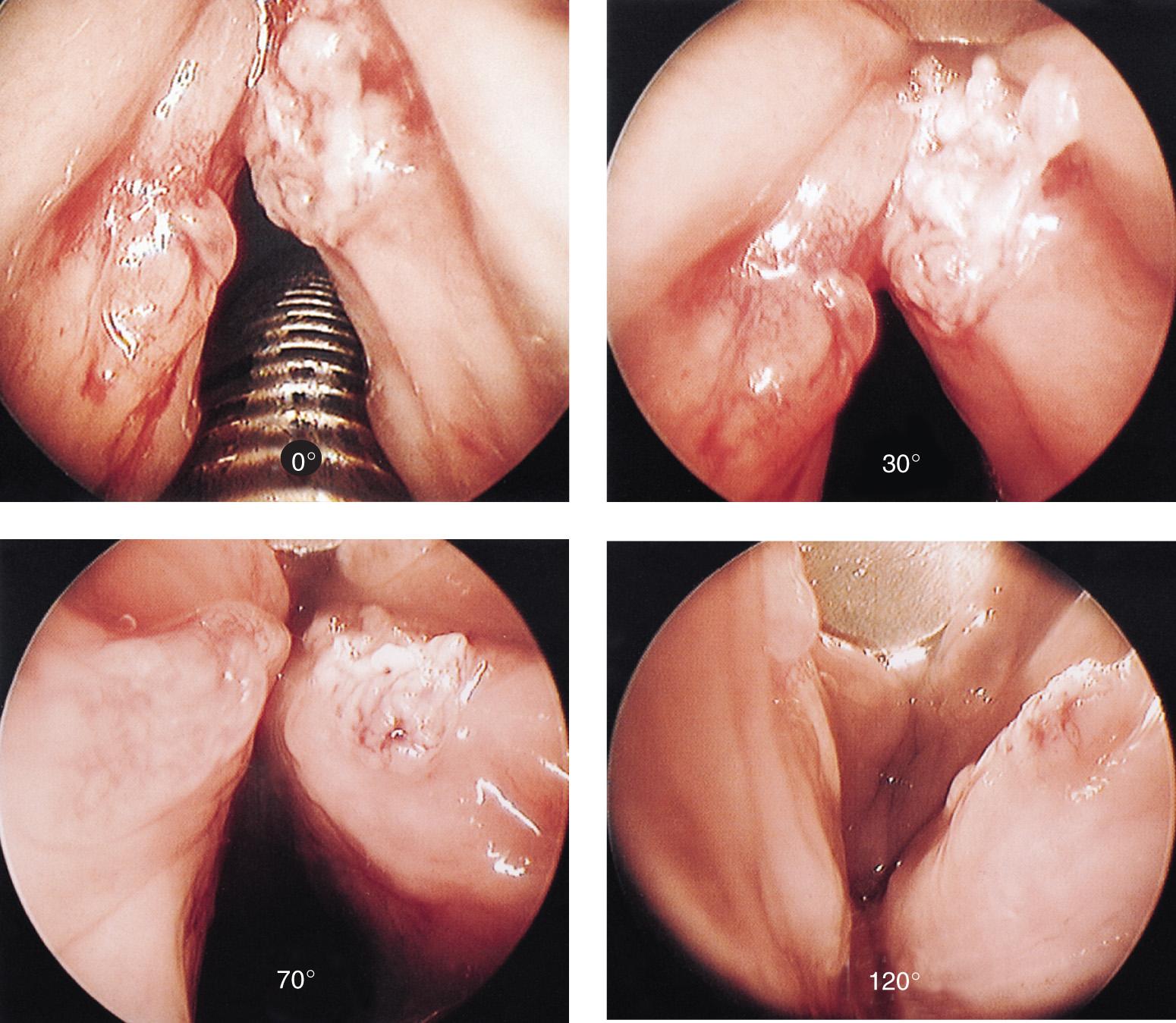 Figure 10.54, The endoscopic view of a recurrent squamous cell carcinoma of the right vocal cord with an edematous left vocal cord through 0-degree, 30-degree, 70-degree, and 120-degree telescopes.