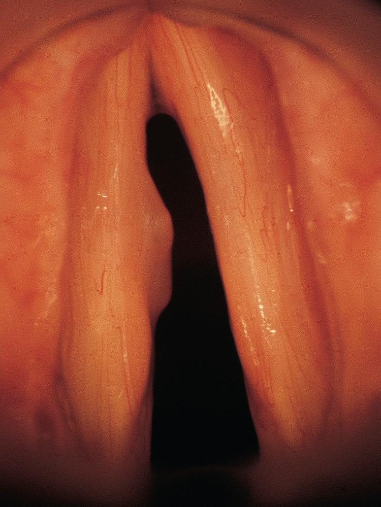 Figure 10.55, An endoscopic view of the larynx showing a mucosal polyp on the free edge of the left vocal cord.