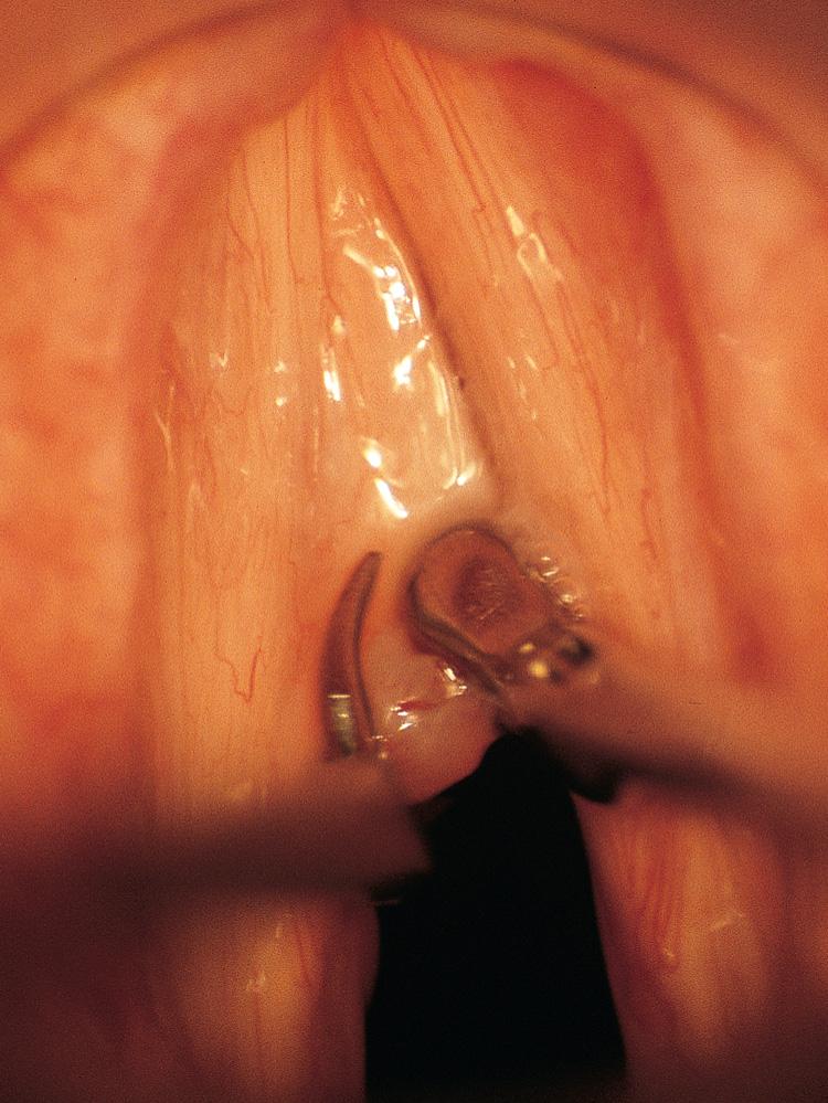 Figure 10.56, The mucosal polyp is grasped with a biopsy forceps and excised with a curved scissors.