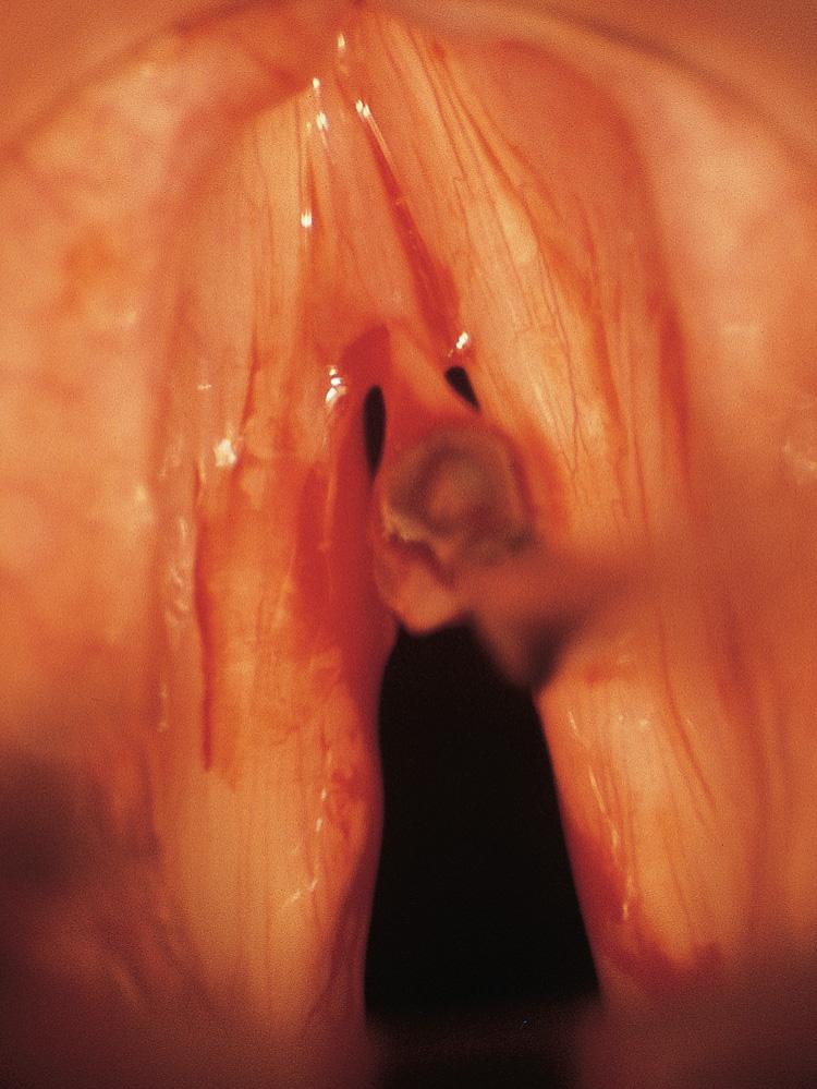 Figure 10.57, Only the mucosa is excised, without any underlying muscle.