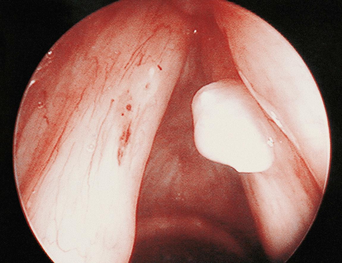 Figure 10.13, Fibrous polyp of the right vocal cord.