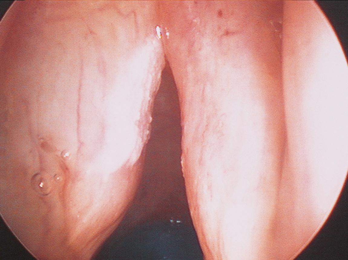 Figure 10.60, An endoscopic view of the larynx showing superficial keratosis of the anterior third of the left vocal cord.