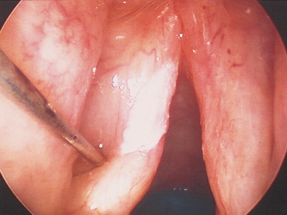 Figure 10.61, A long mediastinal needle is used to inject saline solution.