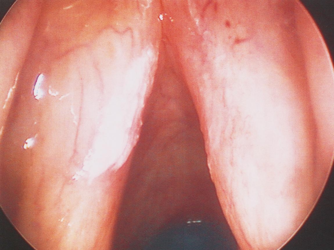 Figure 10.62, Adequate injection of saline solution into the submucosal plane lifts up the lesion from the underlying vocalis muscle.