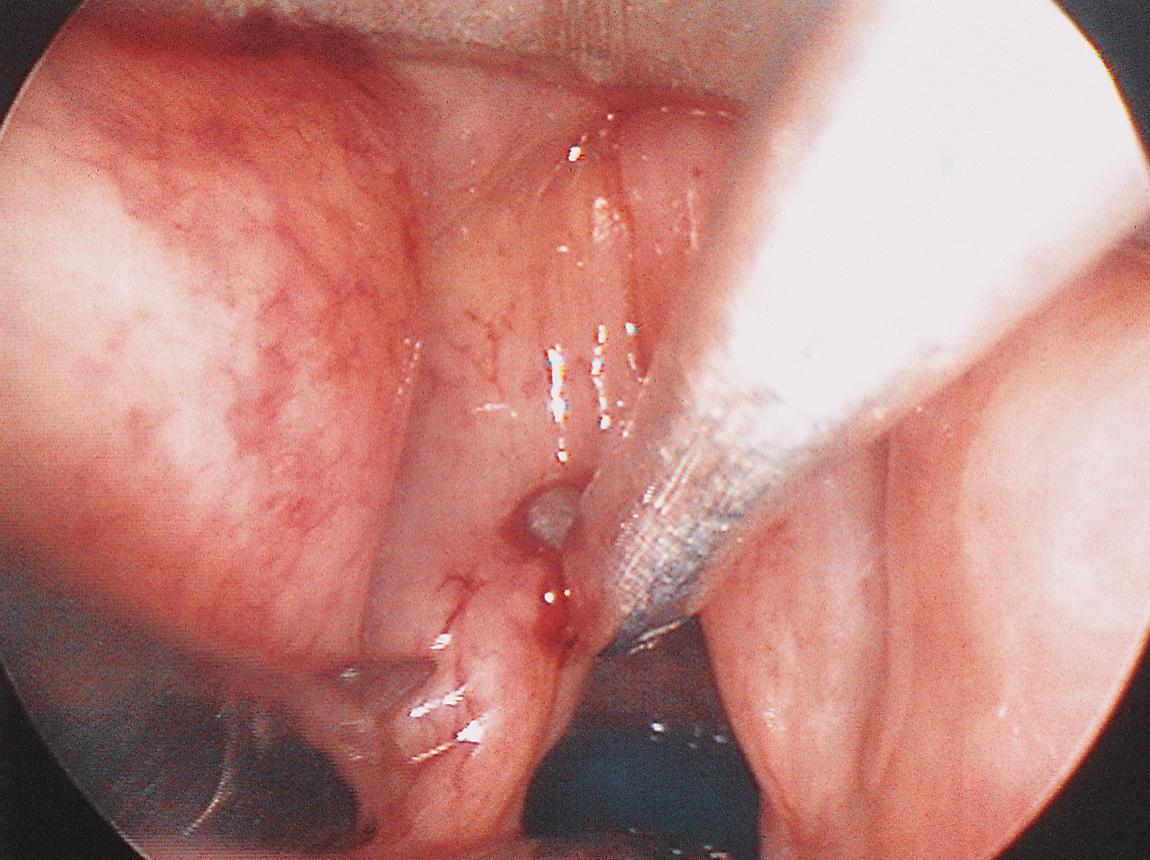 Figure 10.63, The lesion is excised in a monobloc fashion.