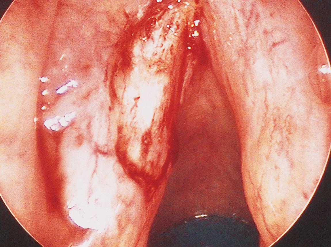 Figure 10.64, The surgical defect.