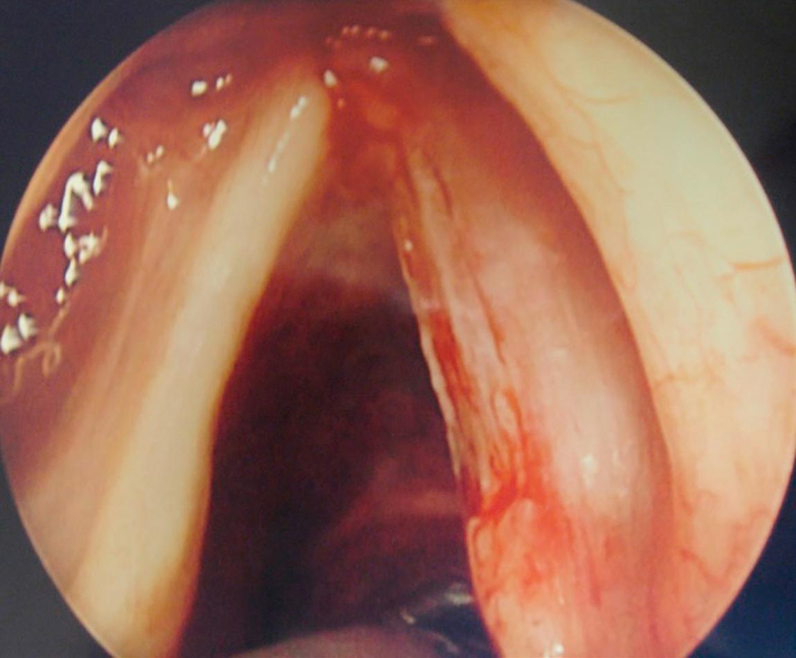 Figure 10.66, Appearance of the vocal cord following microlaryngeal excision of carcinoma in situ of the mucosa.