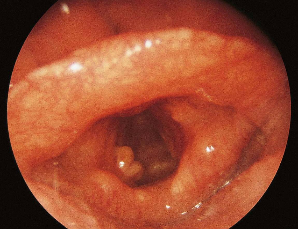 Figure 10.14, Postintubation granuloma of the posterior third of the left vocal cord.