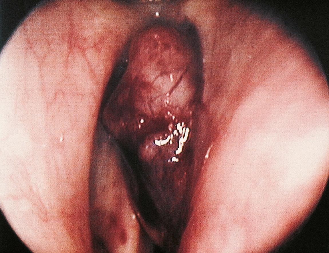 Figure 10.16, Teflon granuloma of the right vocal cord postinjection of Teflon paste for paralyzed vocal cord.