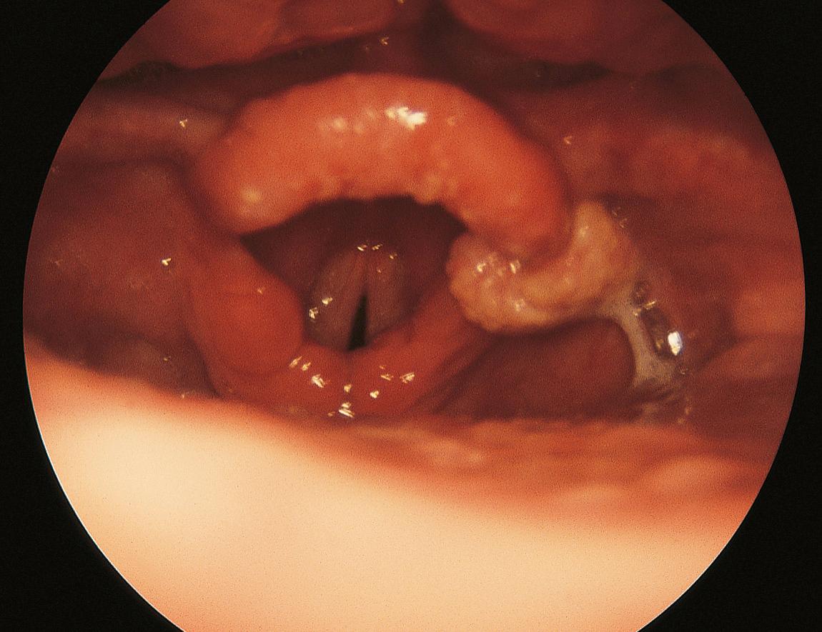 Figure 10.17, Squamous papilloma of the right aryepiglottic fold.