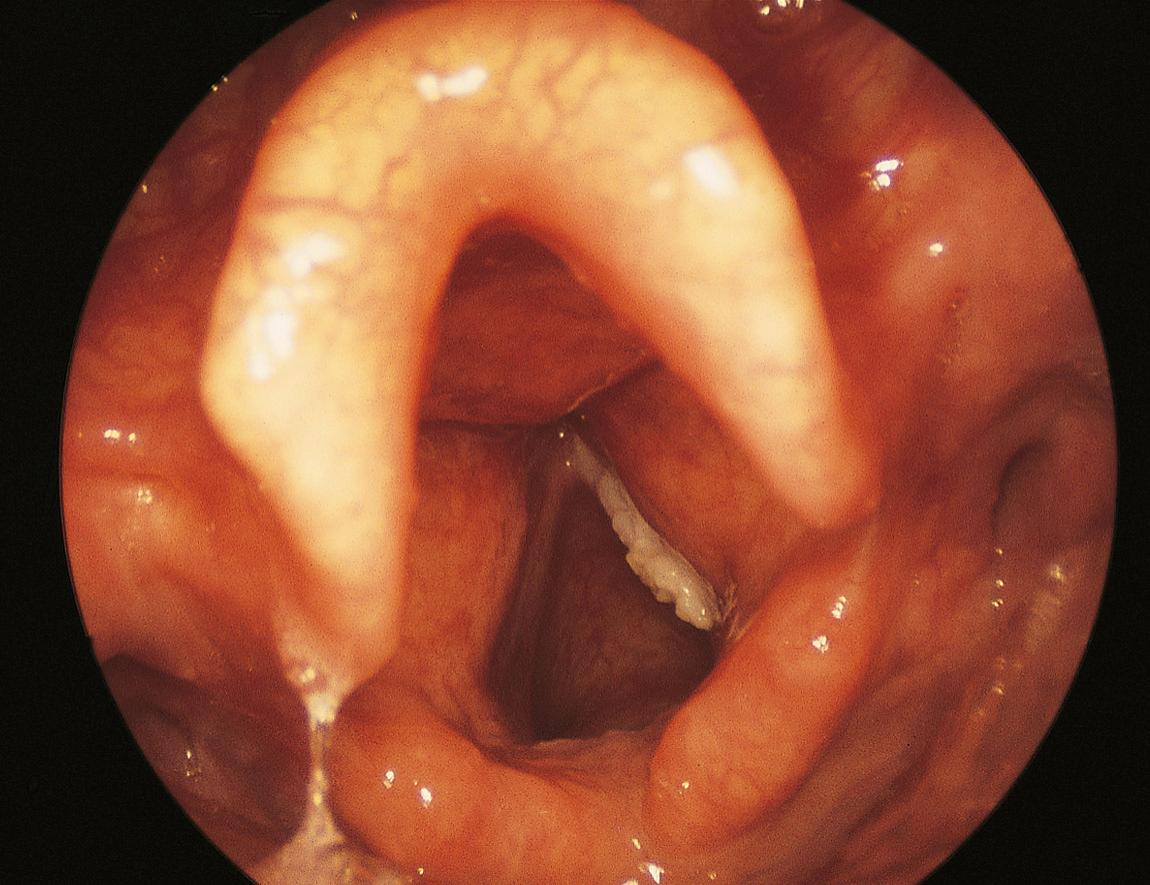 Figure 10.18, Hyperkeratosis of the right vocal cord.