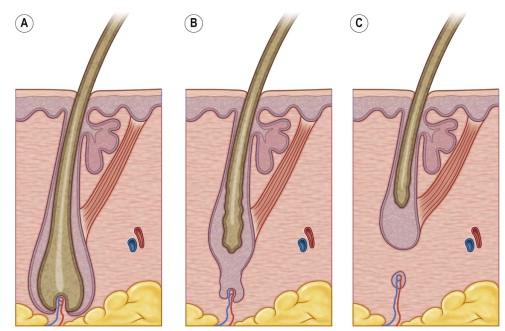 FIGURE 31.2, Stages of hair growth: (A) anagen; (B) catagen; (C) telogen.