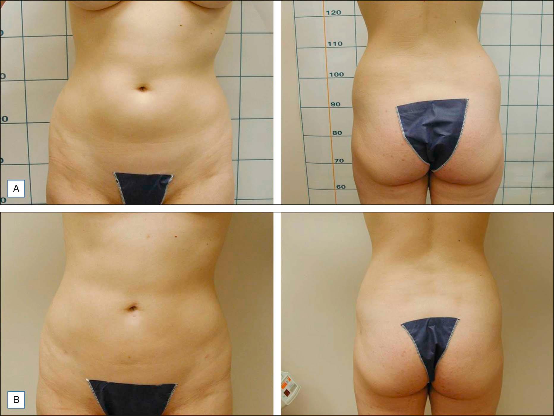 Figure 10.1, (A ) Before and ( B ) 3 months after laser-assisted lipolysis to the abdomen (left) and flanks (right). Note bilateral lower abdomen entry points done with 1.5 mm punch biopsy tool and left to heal by secondary intention