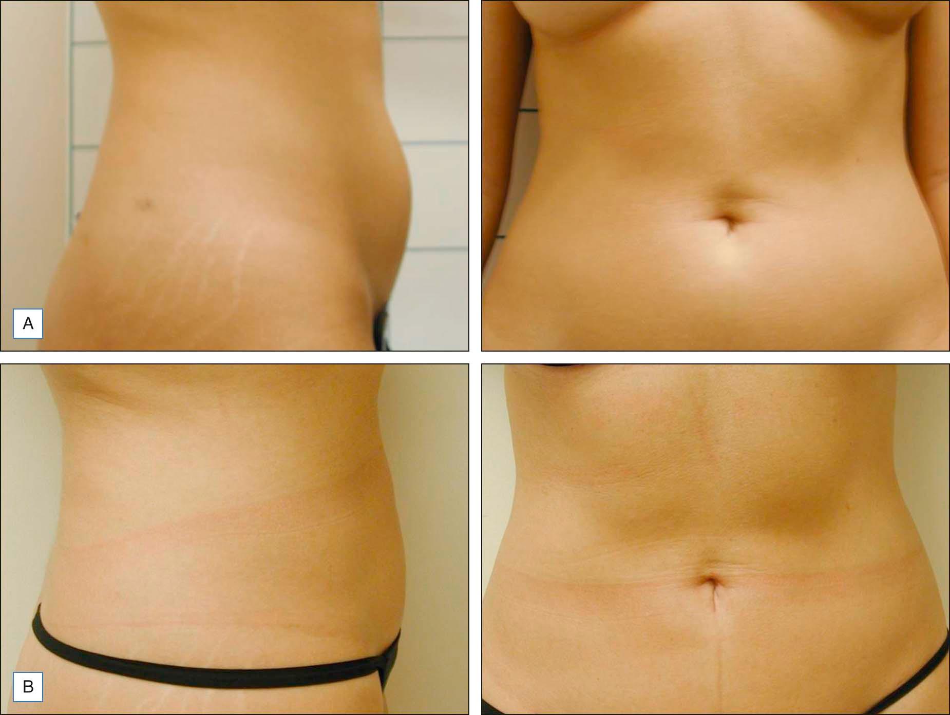 Figure 10.2, (A ) Before and ( B ) 3 months after laser-assisted lipolysis to the abdomen, side view (left) and frontal view (right)